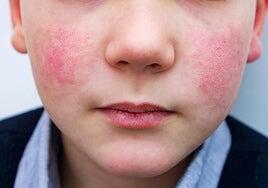 Aumentan los casos de la enfermedad del niño abofeteado: un virus leve y llamativo