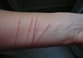 La adicción juvenil a rajarse en brazos y piernas para superar el malestar emocional