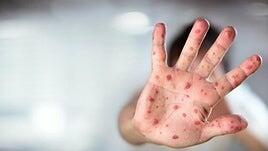 La UE alerta del aumento del sarampión por la caída de las tasas de vacunación