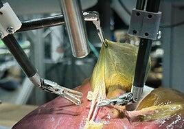 Un robot realiza la primera cirugía sin ayuda humana en un paciente real