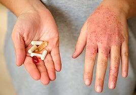 Dermatitis atópica, una enfermedad que te quita el sueño y afecta al crecimiento de los niños