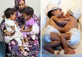 Las siamesas separadas en Barcelona tienen una «vida normal» dos años después