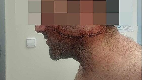 Le rajaron la cara en Málaga cuando esperaba para entrar a trabajar: «Lo han marcado para toda la vida»